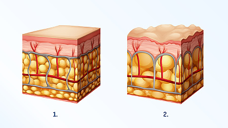 Cellulite - fat cells form typical bumps on the skin