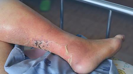 Photo: Leg ulcer