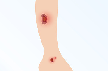 Ulcers also form on the tibia and around the ankle.