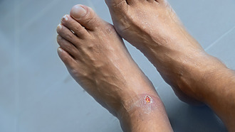 Picture shows what a varicose ulcer on the leg looks like