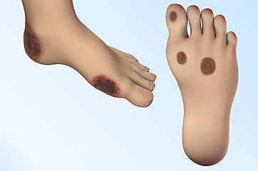 In diabetes, they are often on the fingers on the legs and feet.
