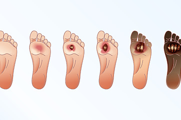 Various sizes and stages of varicose ulcers