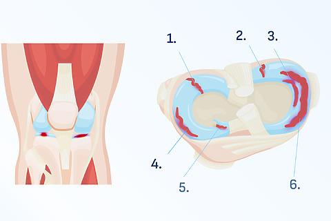 pain on the inside of the knee and pain when squatting - possible signs of meniscus injury