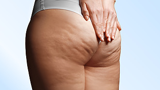 Cellulite buttocks