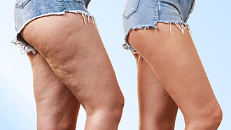 Cellulitis of the legs