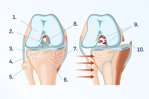 Dislocation of the knee with torn ligaments