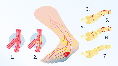 Neuropathy in the foot - problems with the lower limbs mainly affect diabetics