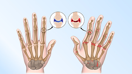 Rheumatoid arthritis most commonly affects the joints of the hands