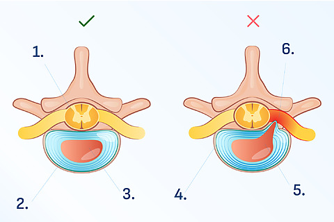 Herniated disc of lumbar vertebrae