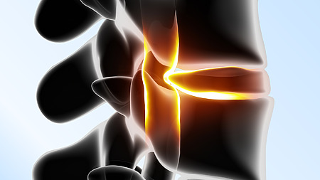 Picture: Slipped disc